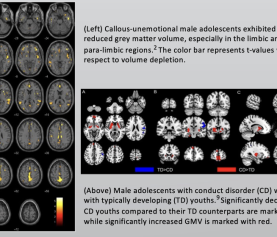 Grey Matter Depletion in Conduct Disorder Adolescents through Magnetic Resonance Imaging Studies